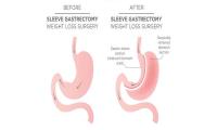 Gastric Sleeve Surgery image 4
