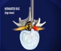 Lumbar Disc Microsurgery in India image 1