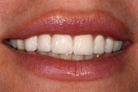 Raleigh Teeth Whitening image 1