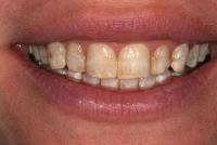 Raleigh Teeth Whitening image 2