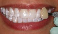 Raleigh Teeth Whitening image 5