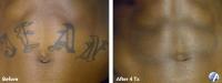 Eraser Clinic Laser Tattoo Removal image 4