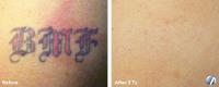 Eraser Clinic Laser Tattoo Removal image 5
