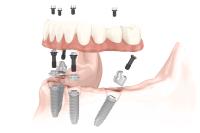 Dental Implant Center San Diego image 1