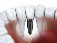 Dental Implant Center San Diego image 2