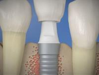 Houston Dental Esthetics image 4