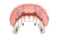 Nepean Dental Implants image 4