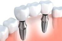 Nepean Dental Implants image 5
