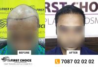 First Choice Hair Transplant & Cosmetics Ludhiana image 2