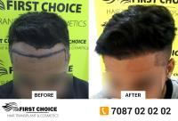 First Choice Hair Transplant & Cosmetics Ludhiana image 3