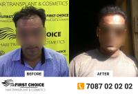 First Choice Hair Transplant & Cosmetics Ludhiana image 4