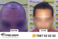 First Choice Hair Transplant & Cosmetics Ludhiana image 5