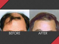 MAXiM Hair Restoration image 3