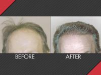 MAXiM Hair Restoration image 4
