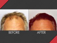 MAXiM Hair Restoration image 5