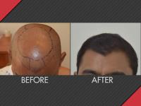 MAXiM Hair Restoration image 6