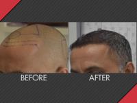 MAXiM Hair Restoration image 7