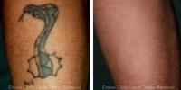 Eraser Clinic Laser Tattoo Removal image 5