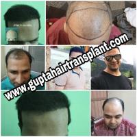 Gupta Hair Transplant image 1