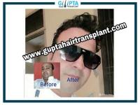 Gupta Hair Transplant image 4
