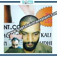 Gupta Hair Transplant image 2