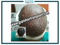 Gupta Hair Transplant image 3