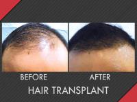 MAXiM Hair Restoration image 1