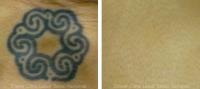 Eraser Clinic Laser Tattoo Removal image 3