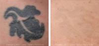Eraser Clinic Laser Tattoo Removal image 6