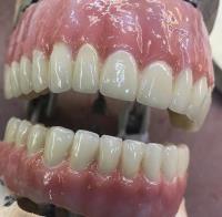 Dental Crowns Lab Trenton image 6