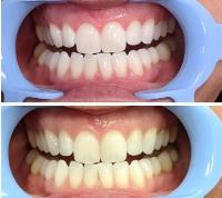 Lumina + Co. Teeth Whitening System image 4