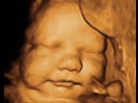 Sweet Previews 3D Ultrasound image 1