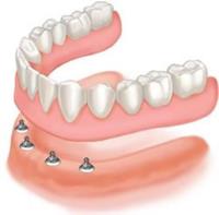 Dental Implants Near Me image 5