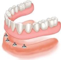 Dental Implants image 2