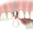 Affordable Dental Implants Albany logo
