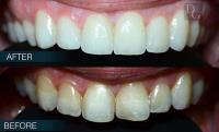 Dental Crowns Lab Lakewood image 3
