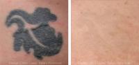 Eraser Clinic Laser Tattoo Removal image 7