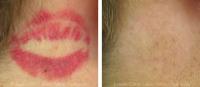 Eraser Clinic Laser Tattoo Removal image 8