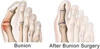 Bunion Surgery Specialists image 1