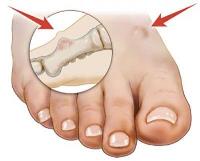 Bunion Surgery Specialists image 2