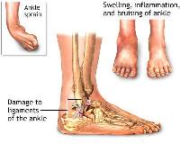 Bunion Surgery Specialists image 3