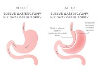 Gastric Sleeve Surgery image 2