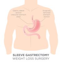 Gastric Sleeve Surgery image 3