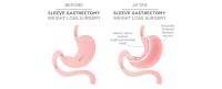 Gastric Bypass Surgery image 5
