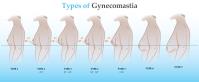 Gynecomastia Cream image 4