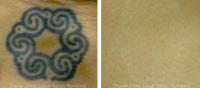 Eraser Clinic Laser Tattoo Removal image 2