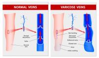 USA Vein Clinics image 14