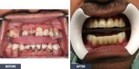 Teeth Implants Albany image 3