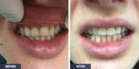 Teeth Implants Albany image 4