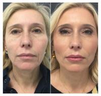 Medical & Acne Treatment Facial image 2